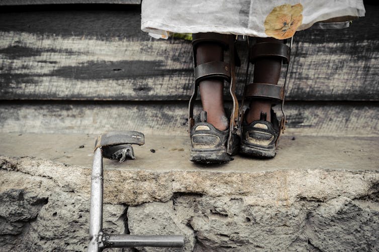 A child with polio wearing callipers. A crutch lies nearby.